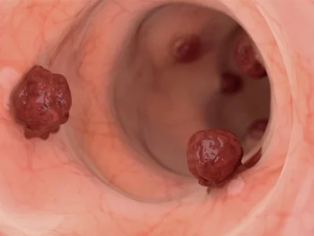 People with intestinal cancer can live a long life by doing this
