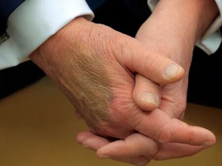The White House explains Trump's hurtful hands in online speculation