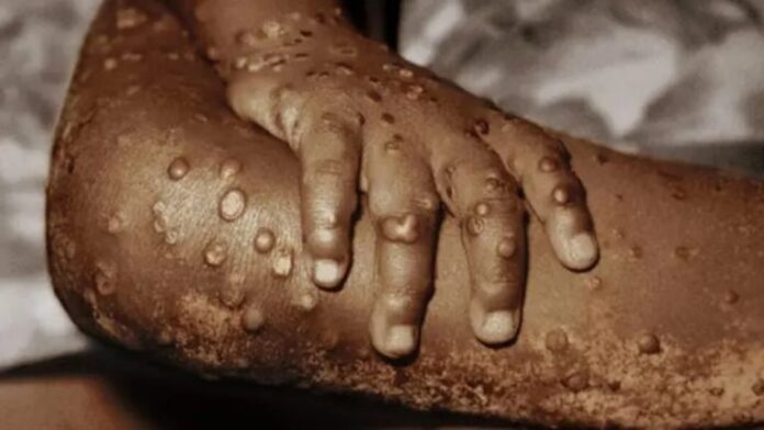 What is Monkeypox Symptoms Causes and Treatment?