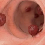People with intestinal cancer can live a long life by
